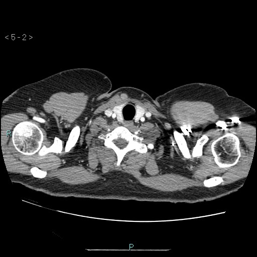 Bronchogenic cyst - posterior mediastinal (Radiopaedia 43885-47364 A 1).jpg