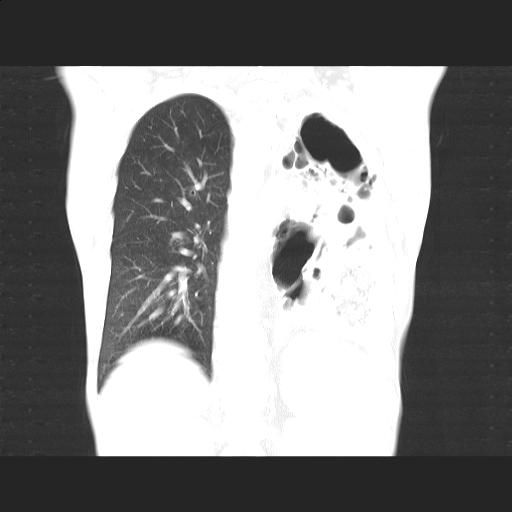 File:Bronchopleural fistula secondary to tuberculosis (Radiopaedia 20415-20322 Coronal lung window 16).jpg