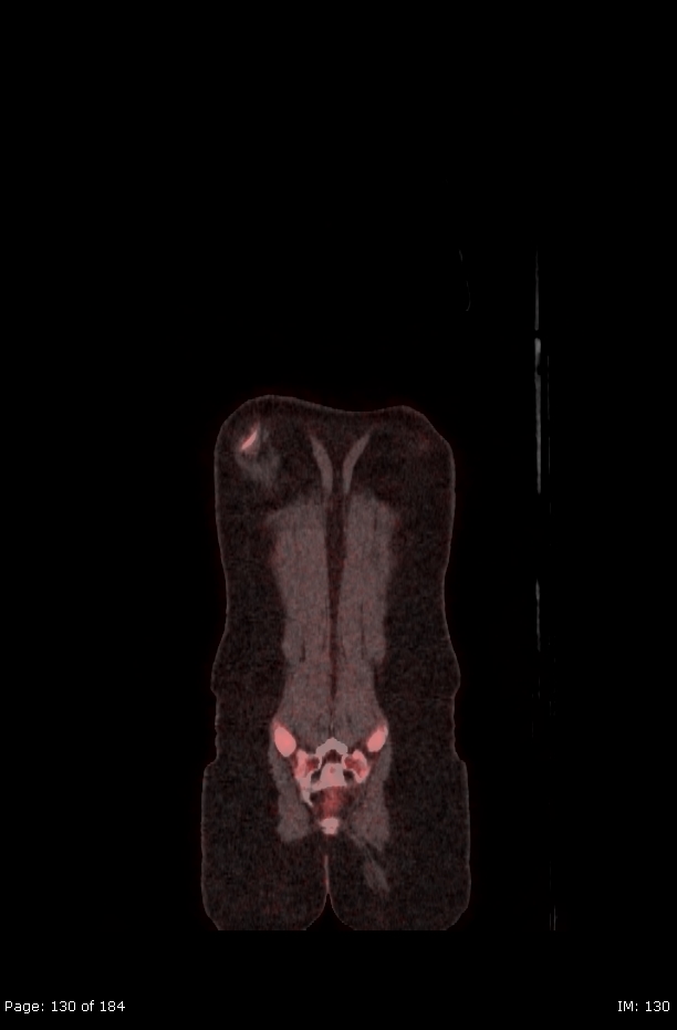 Brown fat uptake (FDG PET-CT) (Radiopaedia 77392-89513 Fused coronal 88).jpg