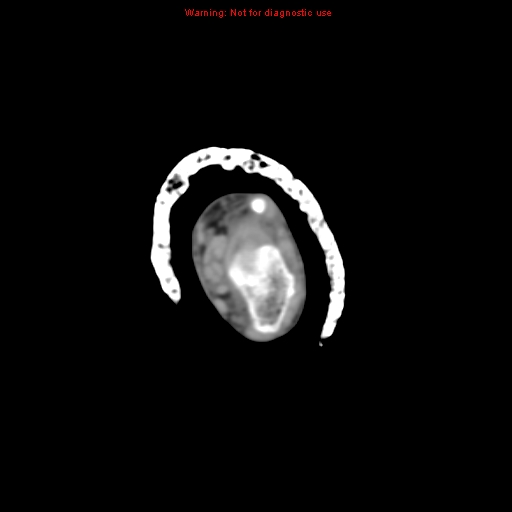 Brown tumor (Radiopaedia 12460-12694 Axial non-contrast 17).jpg