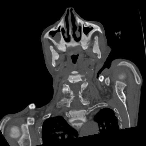 File:Brown tumor with secondary hyperparathyroidism (Radiopaedia 23591-23705 C 28).jpg