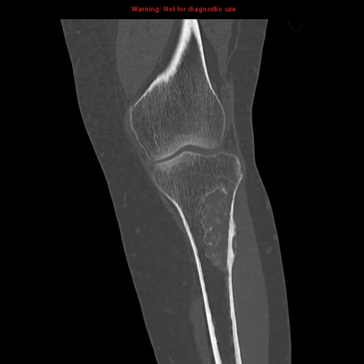File:Brown tumors (Radiopaedia 9666-10291 Coronal bone window 12).jpg