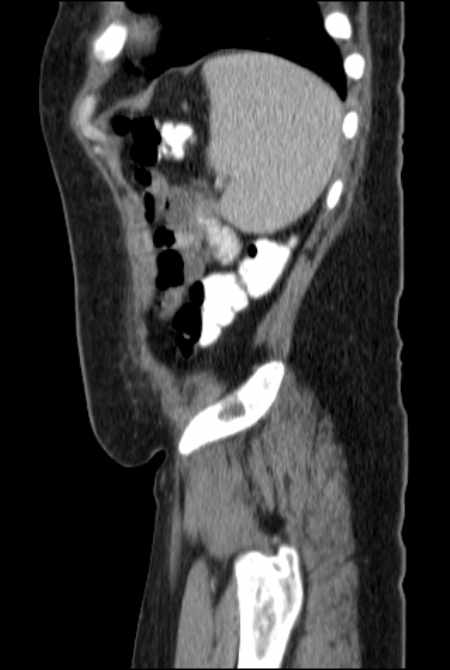 Brown tumors compressing the spinal cord (Radiopaedia 68442-77988 F 48).jpg