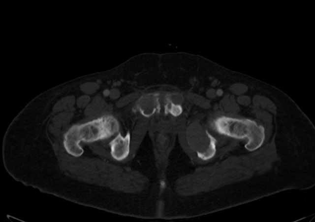 Brown tumors compressing the spinal cord (Radiopaedia 68442-77988 G 127).jpg