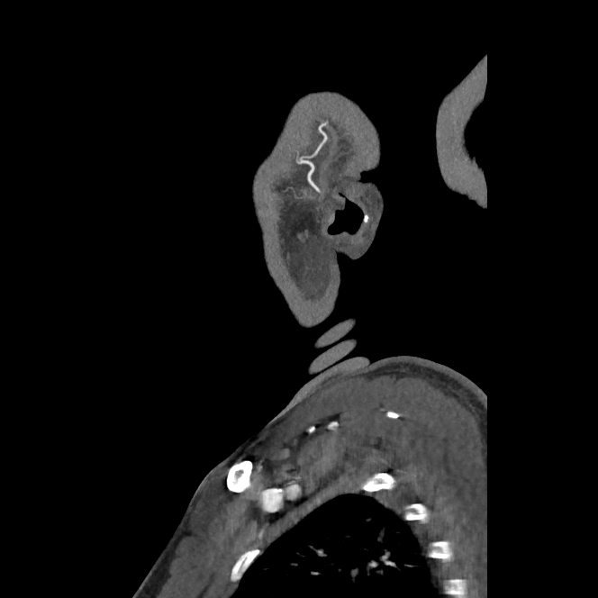 Buccal fat pad arteriovenous malformation (Radiopaedia 70936-81144 C 72).jpg