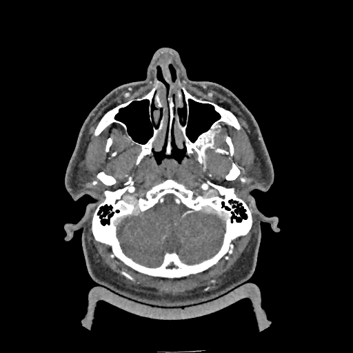 Buccal fat pad arteriovenous malformation (Radiopaedia 70936-81144 D 238).jpg