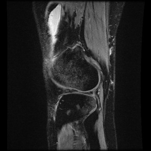 Bucket handle meniscus tear (Radiopaedia 56916-63751 H 13).jpg
