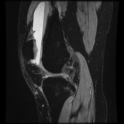 Bucket handle meniscus tear (Radiopaedia 56916-63751 H 50).jpg
