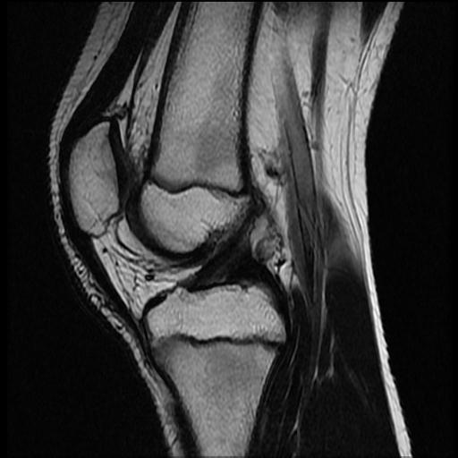 File:Bucket handle tear - lateral meniscus (Radiopaedia 72124-82634 Sagittal T2 8).jpg
