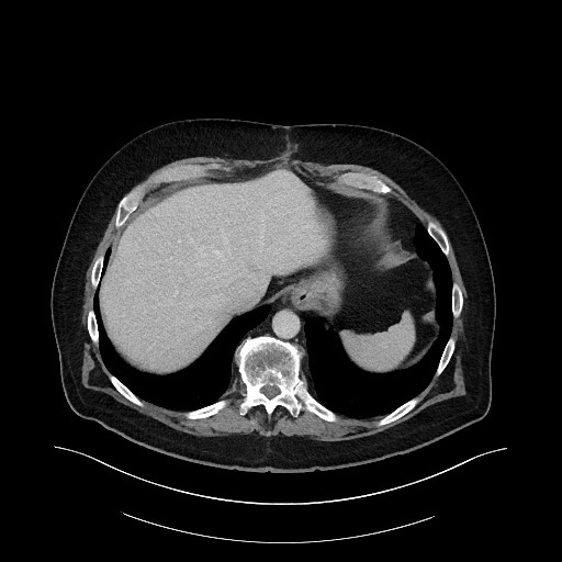 Buried bumper syndrome - gastrostomy tube (Radiopaedia 63843-72575 A 2).jpg
