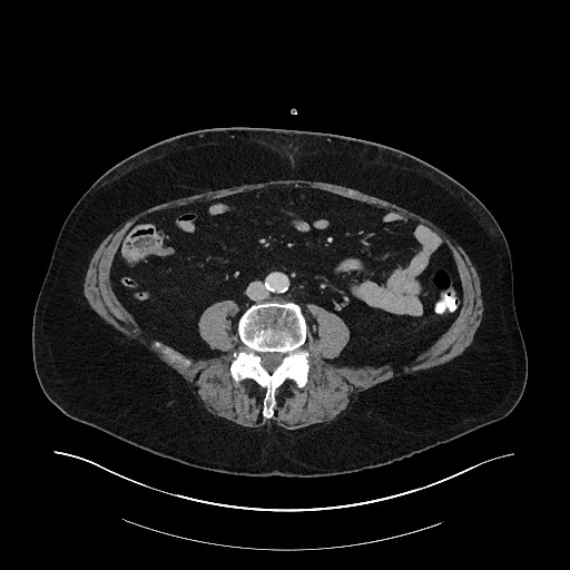 File:Buried bumper syndrome - gastrostomy tube (Radiopaedia 63843-72575 Axial 56).jpg