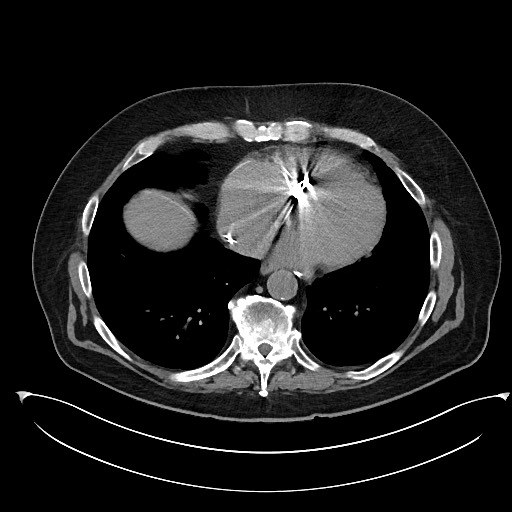 File:Buried bumper syndrome - gastrostomy tube (Radiopaedia 63843-72577 Axial Inject 2).jpg