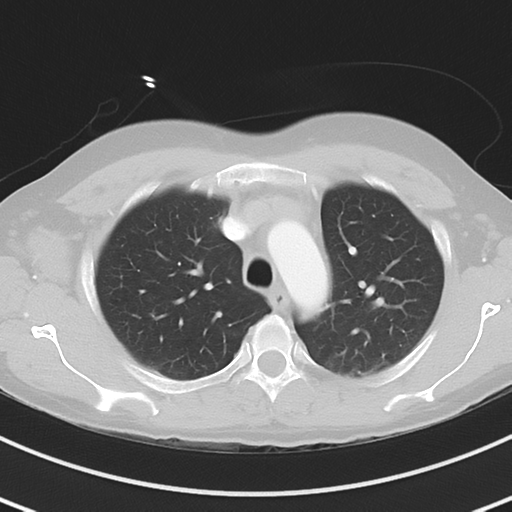 Burkitt lymphoma (Radiopaedia 34686-36121 Axial lung window 14).png