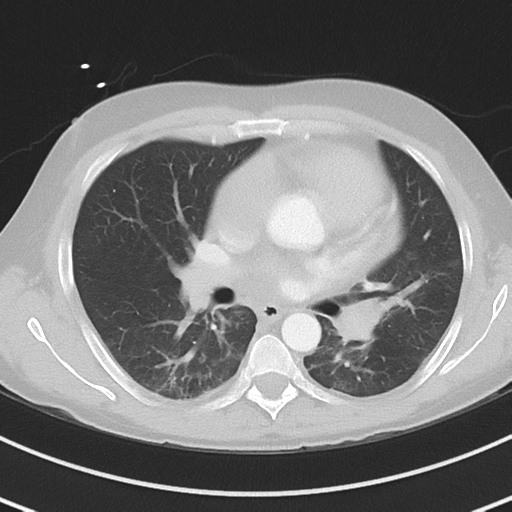 Burkitt lymphoma (Radiopaedia 34686-36121 Axial lung window 25).png