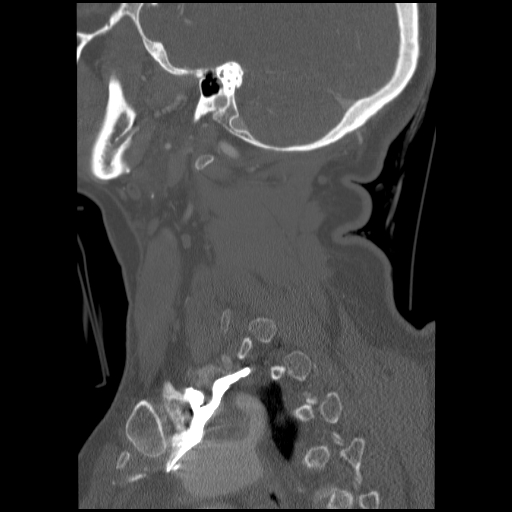 File:C1 anterior arch (plough) fracture - type 1 (Radiopaedia 76181-87720 Sagittal bone window 30).jpg
