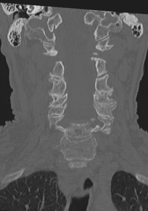 C2 fracture with vertebral artery dissection (Radiopaedia 37378-39199 Coronal bone window 21).png