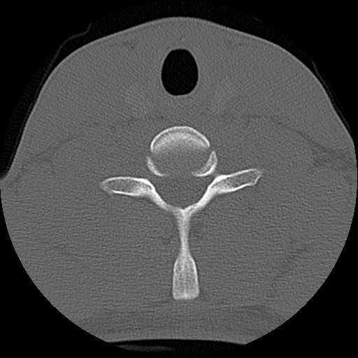 File:C5 facet fracture (Radiopaedia 58374-65499 Axial bone window 67).jpg