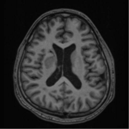 CNS vasculitis (Radiopaedia 55715-62263 Axial T1 44).png