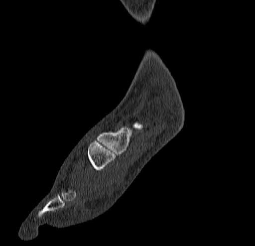 File:Calcaneal fracture - Sanders type 4 (Radiopaedia 90179-107370 Sagittal bone window 26).jpg