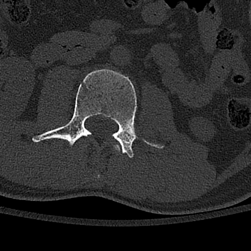 Calcaneal fractures with associated L2 burst fracture (Radiopaedia 71671-82493 Axial bone window 70).jpg