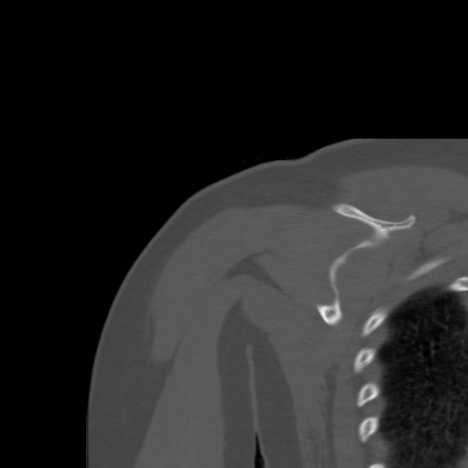 File:Calcific tendinitis of the infraspinatus tendon (Radiopaedia 87256-103539 Coronal bone window 43).jpg