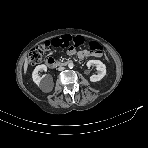 Calcified adrenal glands and Spigelian hernia (Radiopaedia 49741-54988 A 103).jpg