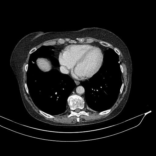Calcified adrenal glands and Spigelian hernia (Radiopaedia 49741-54988 A 7).jpg