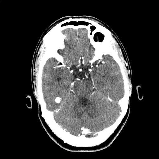 Calcified cerebral hydatid cyst (Radiopaedia 65603-74717 Axial with contrast 22).jpg