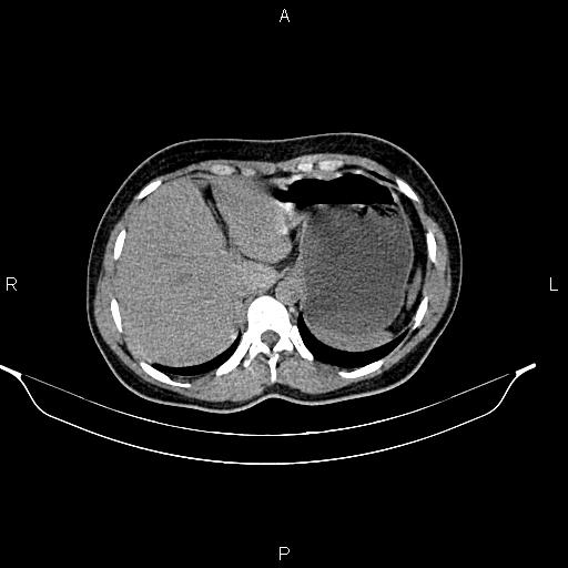 File:Calcified hepatic hydatid cyst (Radiopaedia 84672-100095 Axial non-contrast 23).jpg