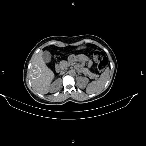 File:Calcified hepatic hydatid cyst (Radiopaedia 84672-100095 Axial non-contrast 32).jpg