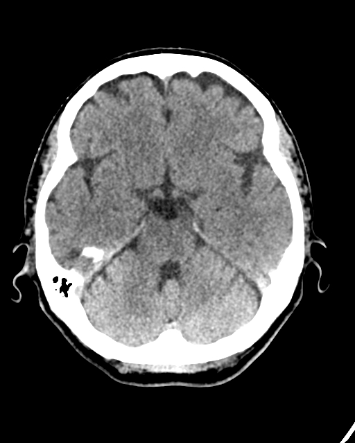 Calcified meningioma (Radiopaedia 74361-85243 Axial non-contrast 34).jpg