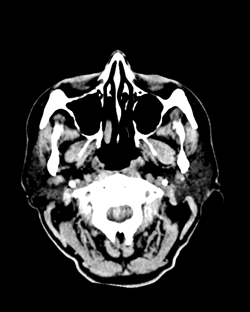 Calcified meningioma (Radiopaedia 74361-85243 Axial non-contrast 53).jpg