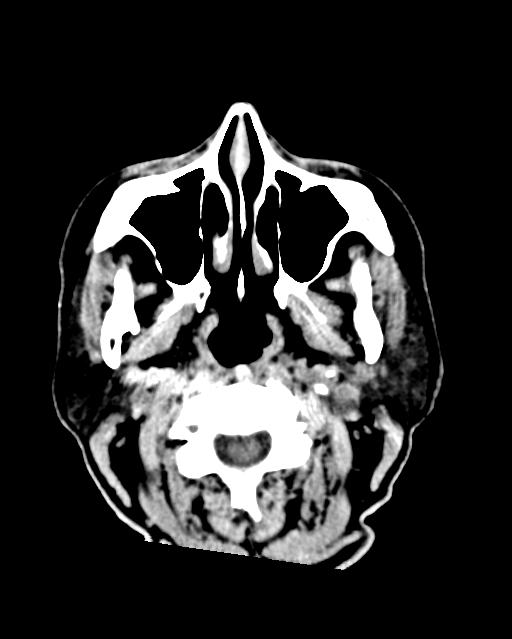 Calcified meningioma (Radiopaedia 74361-85243 Axial non-contrast 56).jpg