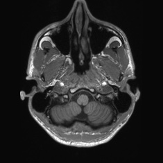 Callosal dysgenesis with interhemispheric cyst (Radiopaedia 53355-59335 Axial T1 18).jpg