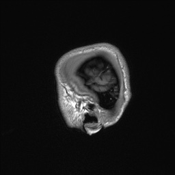 Callosal dysgenesis with interhemispheric cyst (Radiopaedia 53355-59335 Sagittal T1 14).jpg