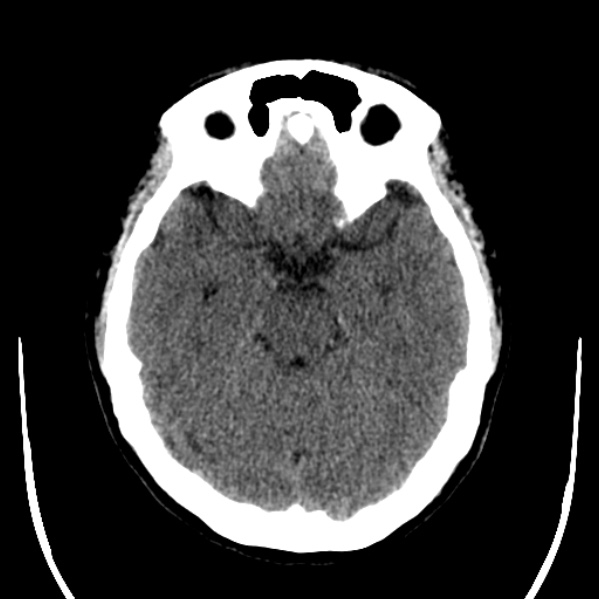 Calvarial osteoma (Radiopaedia 36520-38079 Axial non-contrast 20).jpg