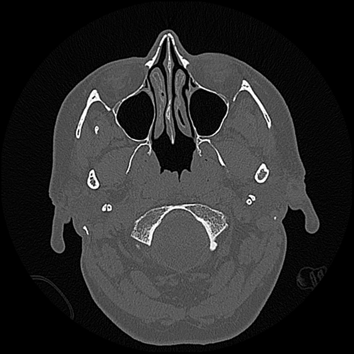Canal up mastoidectomy (Radiopaedia 78108-90638 Axial bone window 6).jpg