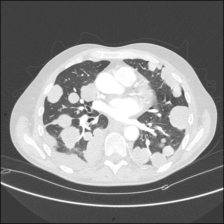 Cannonball metastases (Radiopaedia 82110-96150 Axial lung window 109).jpg