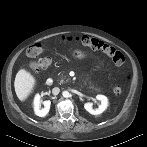 Cannonball metastases from endometrial cancer (Radiopaedia 42003-45031 E 31).png
