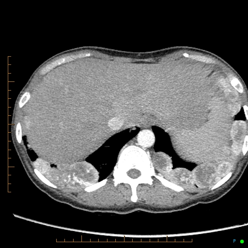 Canonball lung metastasis (Radiopaedia 77634-89837 B 89).jpg