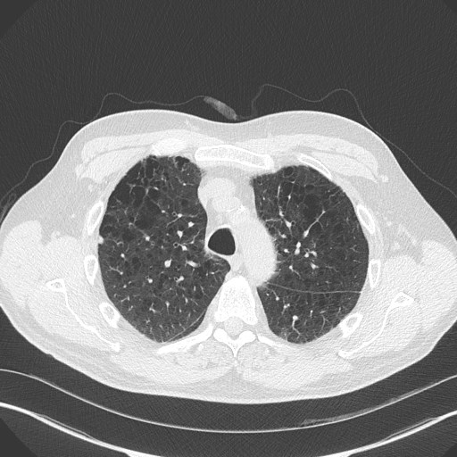 Caplan syndrome (Radiopaedia 56667-63530 Axial lung window 61).jpg