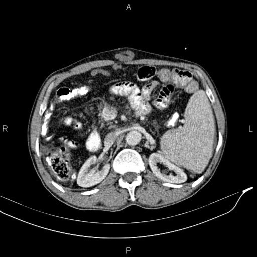Caput medusae sign - portal hypertension (Radiopaedia 64007-72759 A 33).jpg