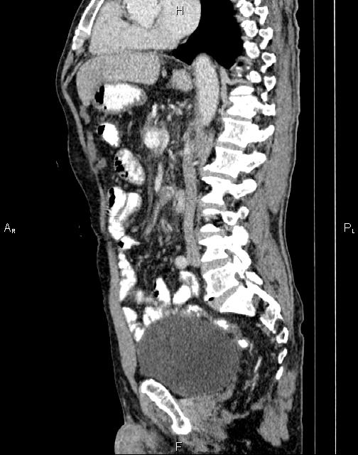 Caput medusae sign - portal hypertension (Radiopaedia 64007-72759 B 37).jpg