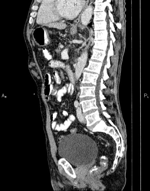 Caput medusae sign - portal hypertension (Radiopaedia 64007-72759 B 46).jpg
