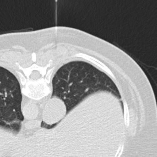 File:Carcinoid tumor - lung (Radiopaedia 44814-48644 Axial lung window 21).png