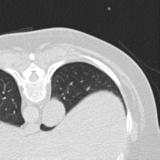 File:Carcinoid tumor - lung (Radiopaedia 44814-48644 Axial lung window 82).png