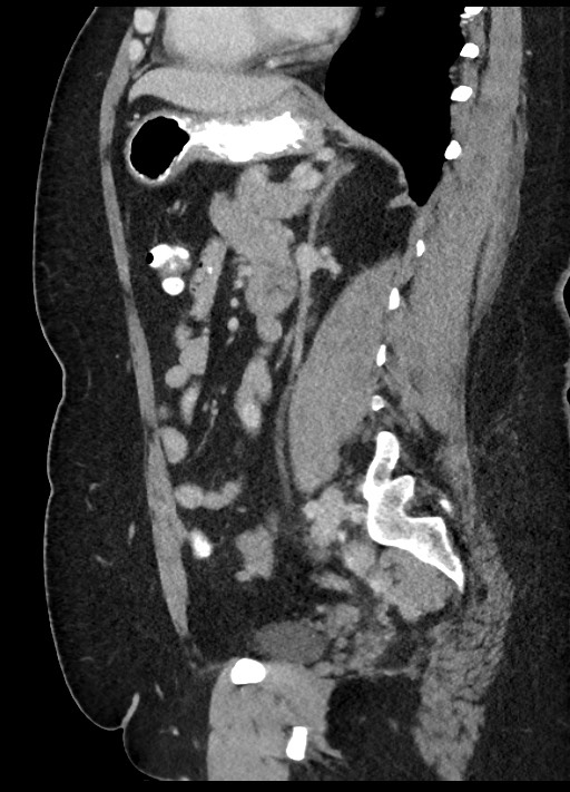Carcinoid tumor - terminal ileum (Radiopaedia 60931-68739 C 36).jpg