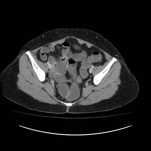 File:Carcinoma colon - hepatic flexure (Radiopaedia 19461-19493 A 109).jpg