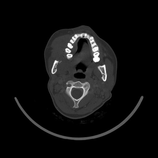 Carcinoma of the maxillary antrum (Radiopaedia 53805-59888 Axial bone window 81).jpg