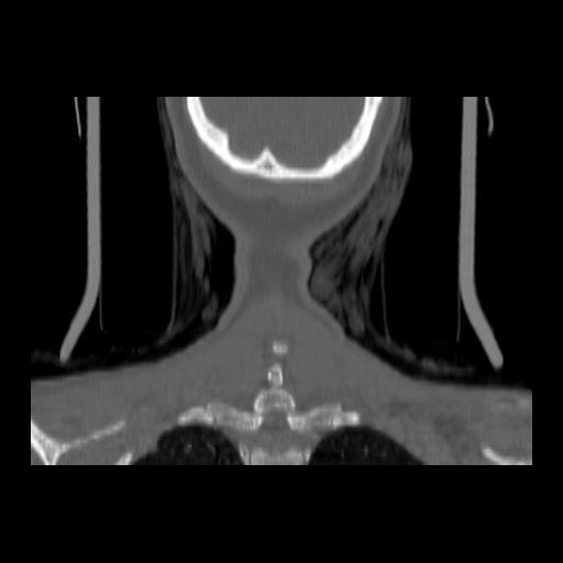 Carcinoma of the maxillary antrum (Radiopaedia 53805-59888 Coronal bone window 145).jpg